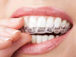 Teeth Grinding Guards